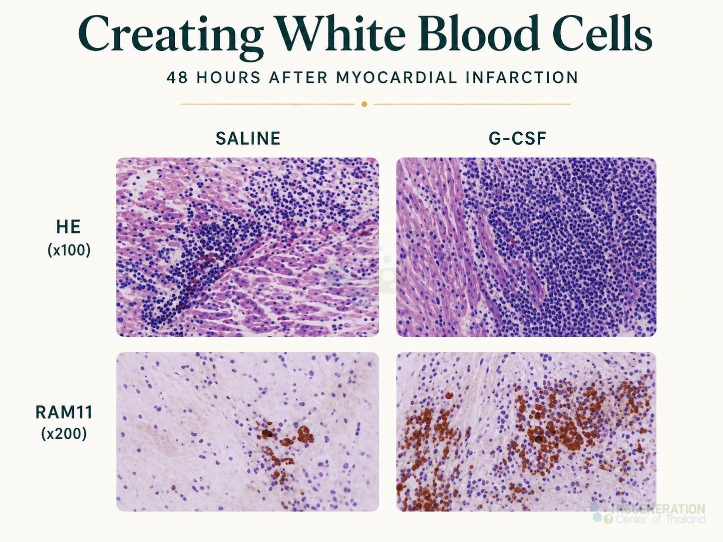 Histology comparison 48 hours after myocardial infarction with saline and G-CSF treatment groups for Granulocyte Colony-Stimulating Factor G-CSF Stimulation.