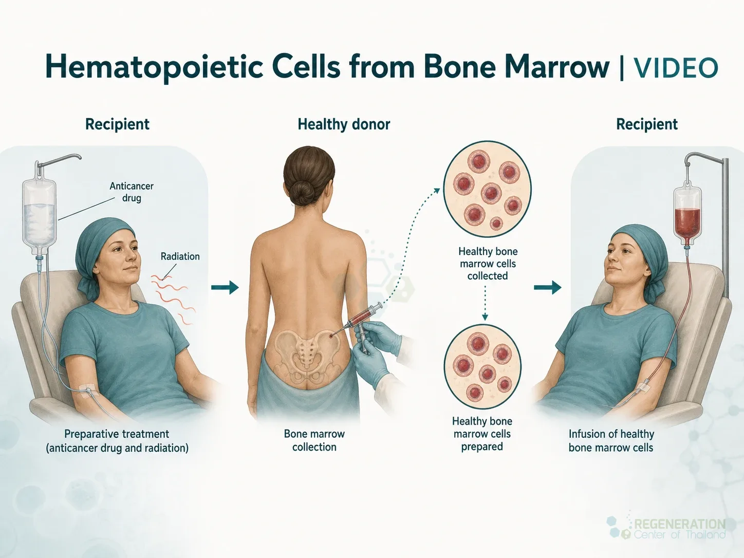Bone marrow transplant process, unverified draft for review