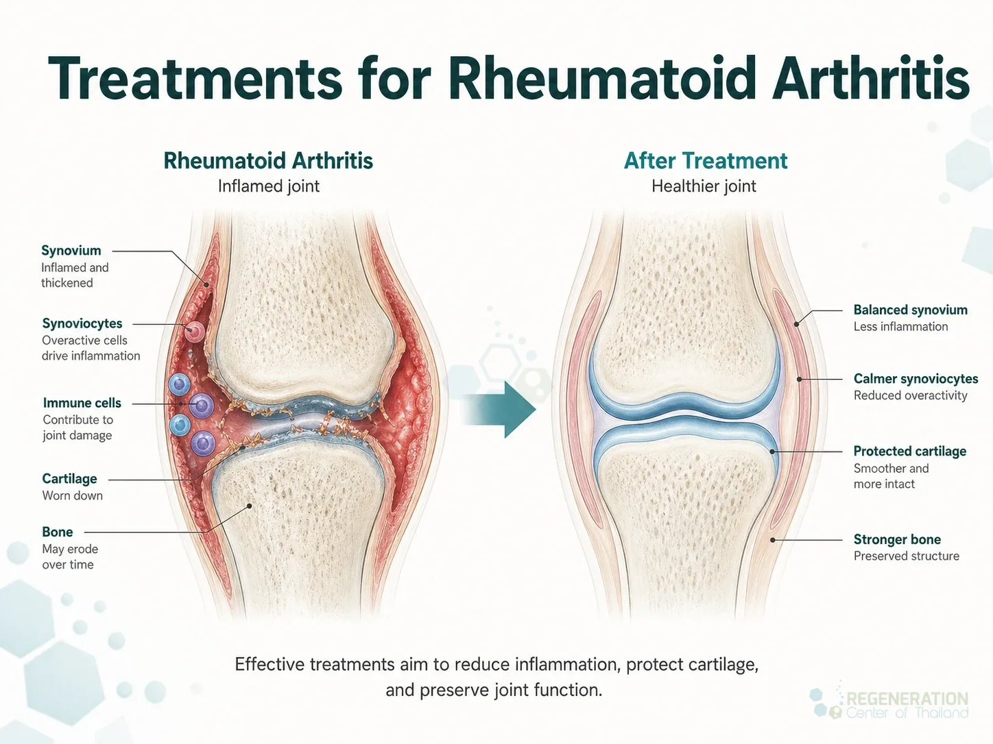 Clinical editorial image for Treatments for Rheumatoid Arthritis, including the section headline.