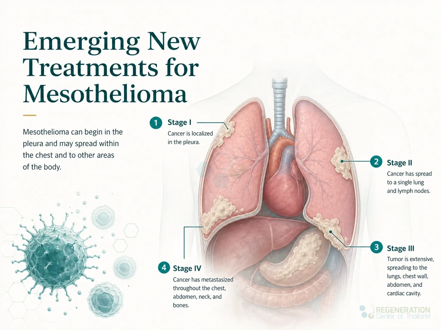Clean clinical illustration for Emerging New Treatments for Mesothelioma with concise explanatory text.