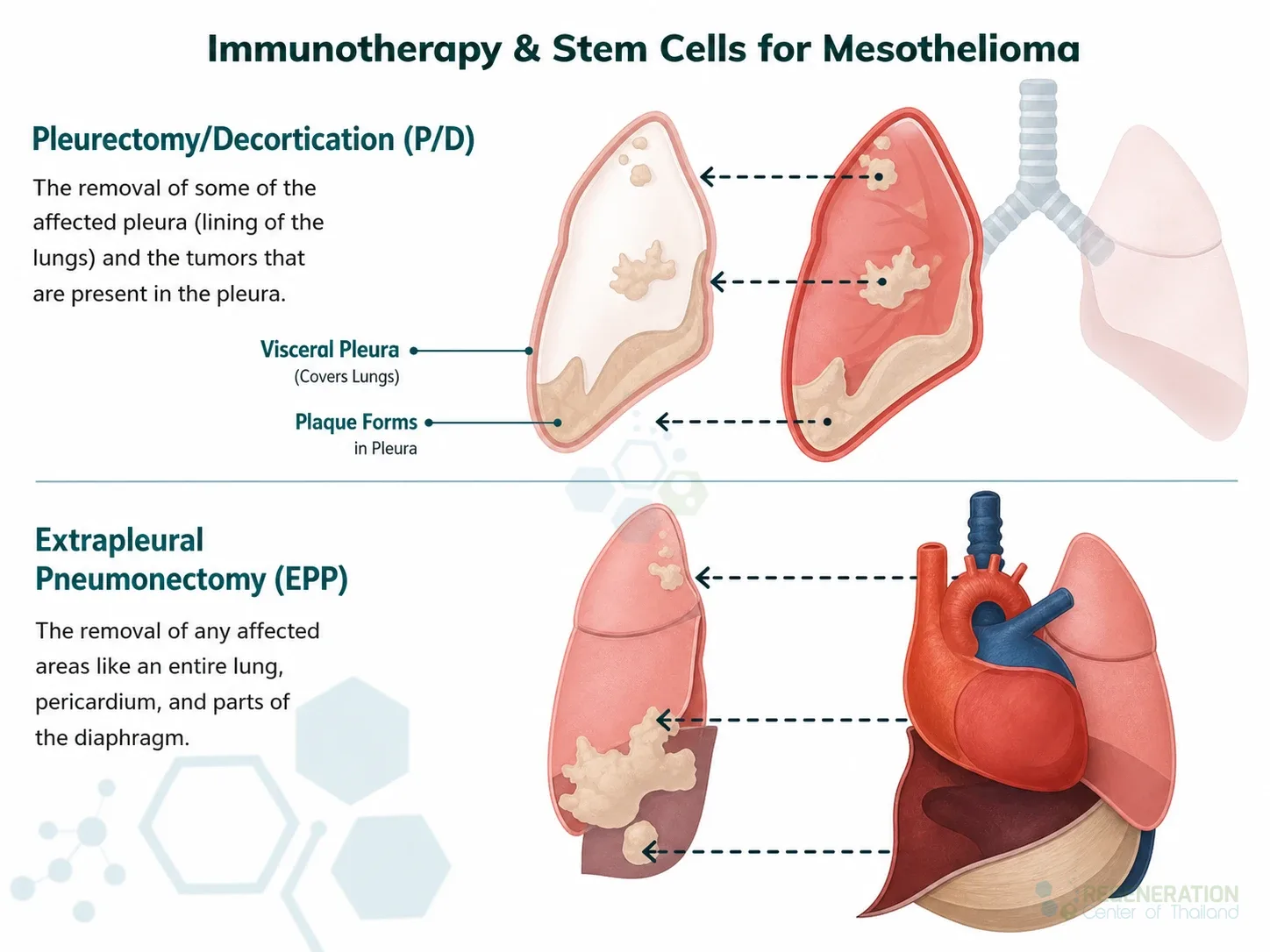 Editorial illustration for Immunotherapy & Stem Cells for Mesothelioma, including the authored section headline.