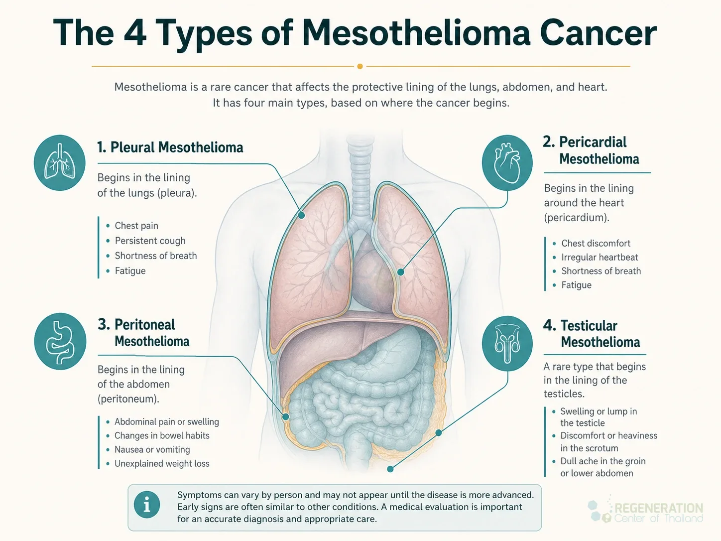 Clean clinical illustration for The 4 Types of Mesothelioma Cancer with concise explanatory text.