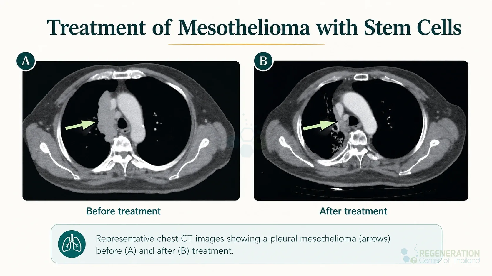 Editorial illustration for Treatment of Mesothelioma with Stem CellsΒ , including the authored section headline.