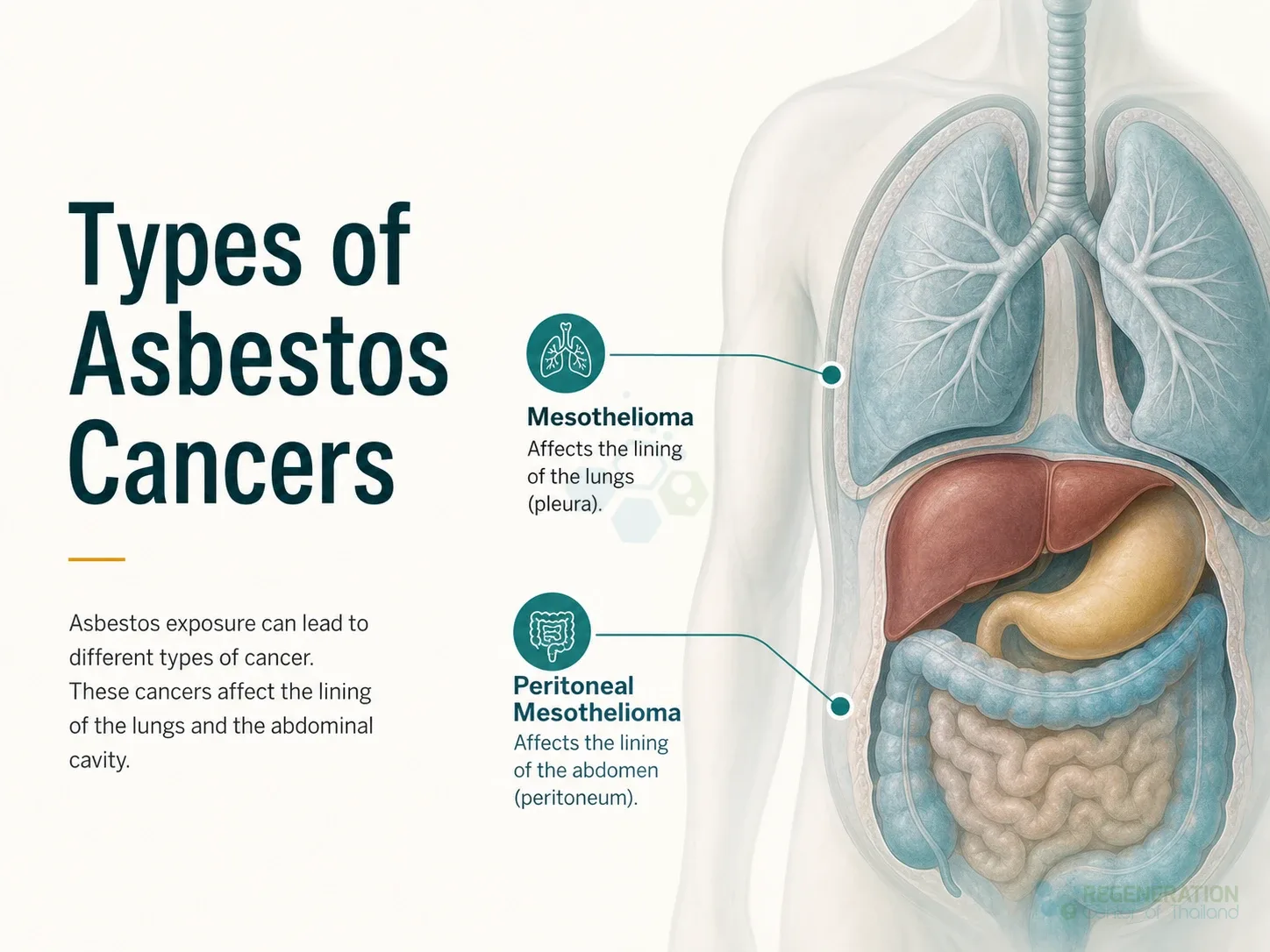 Clean clinical illustration for Types of Asbestos Cancers with concise explanatory text.
