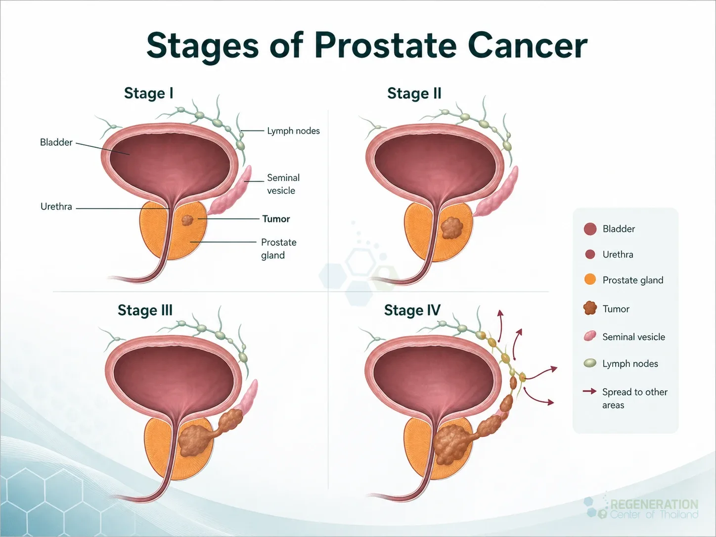Clean clinical illustration for Stages of Prostate Cancer with concise explanatory text.