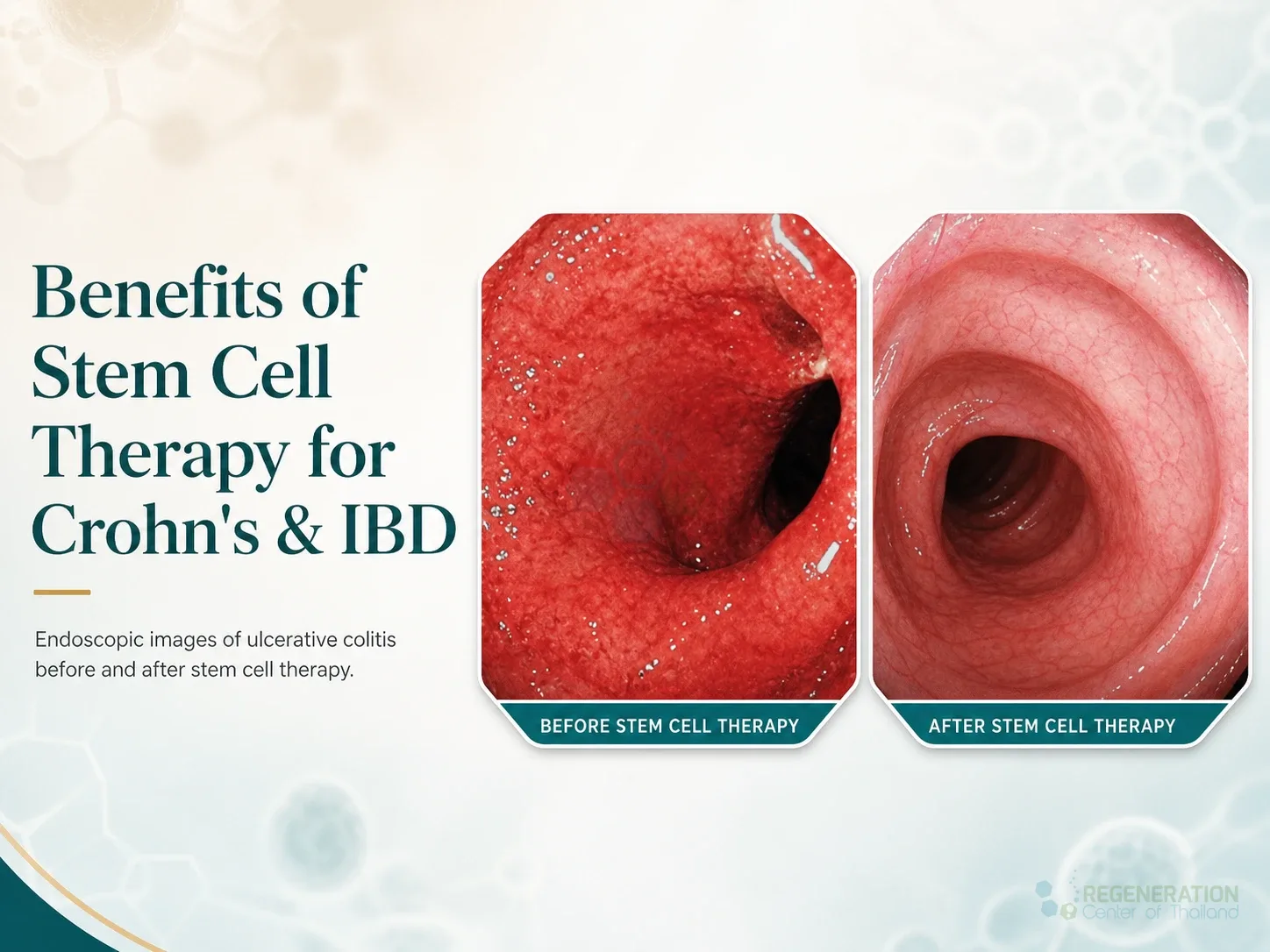 Editorial image for Benefits of Stem Cell Therapy for Crohn's & IBD, including the section headline.