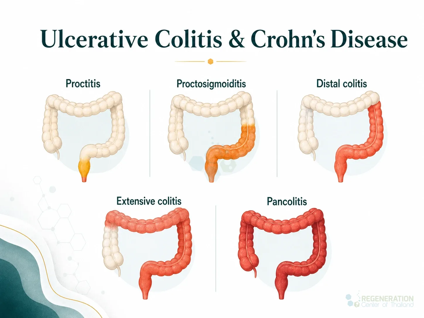 Clinical editorial image for  Ulcerative Colitis & Crohn's Disease, including the section headline.
