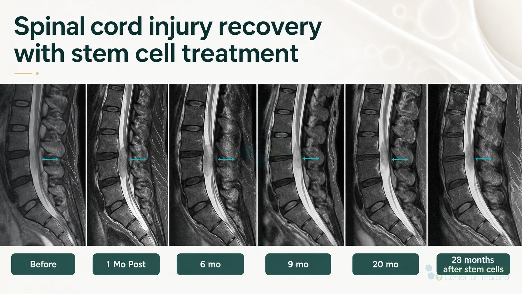 Editorial image for Spinal cord injury recovery with stem cell treatment, including the section headline.