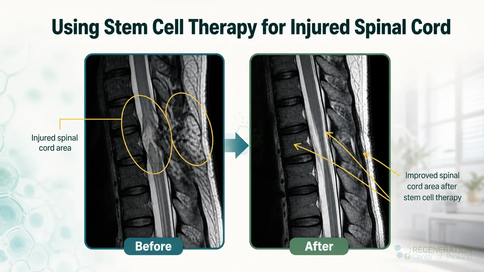 Editorial image for Using Stem Cell Therapy for Injured Spinal Cord, including the section headline.