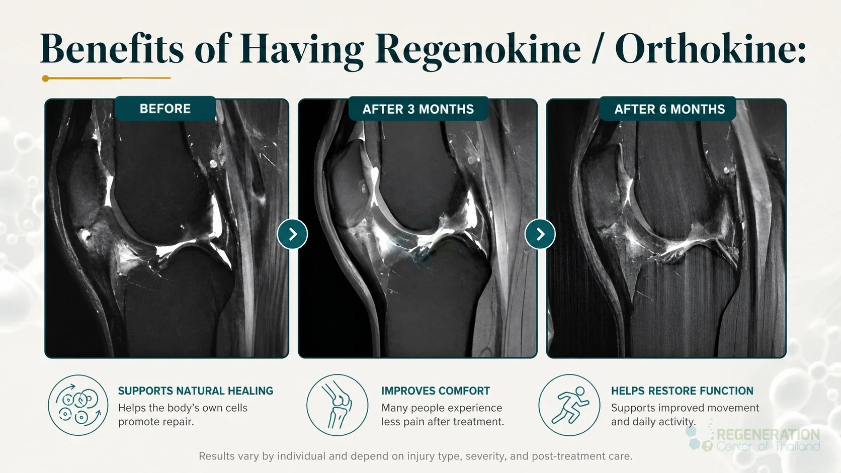 Editorial image for Benefits of Having Regenokine / Orthokine:, including the section headline.