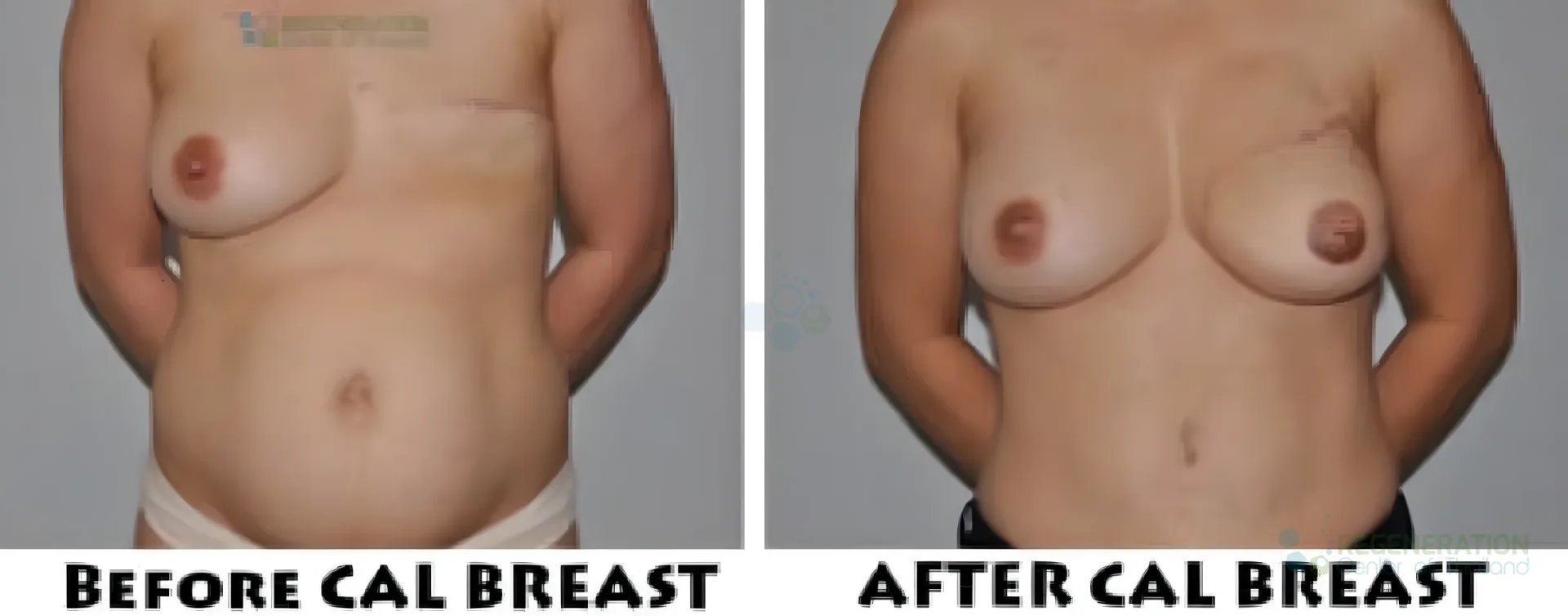Enhanced visual alternative for Before-and-after clinical photographs of cell-assisted breast reconstruction