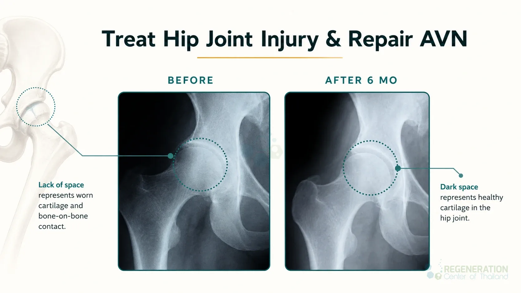 Clinical editorial image for Treat Hip Joint Injury & Repair AVN, including the section headline.