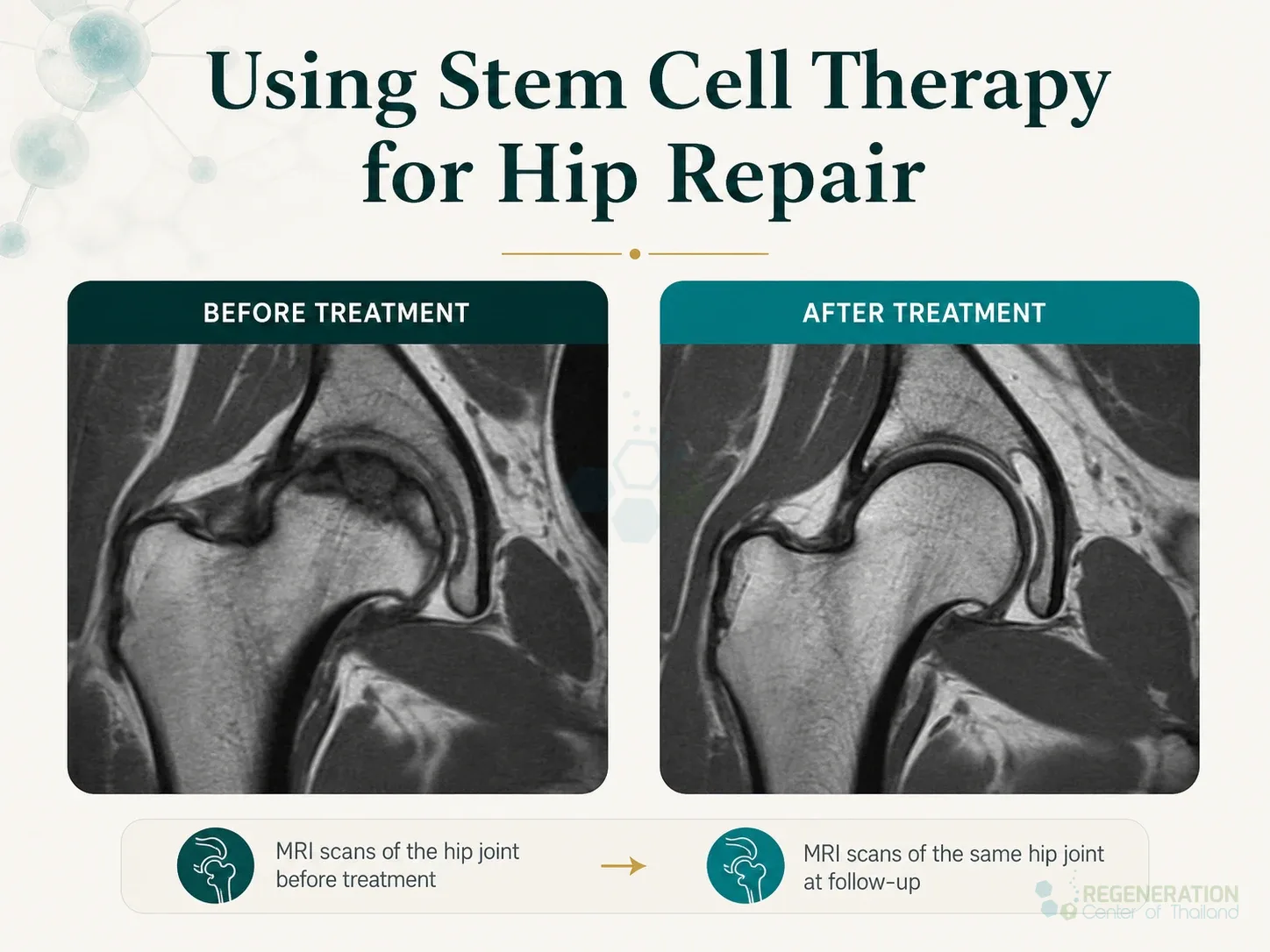 Clinical editorial image for Using Stem Cell Therapy for Hip Repair, including the section headline.
