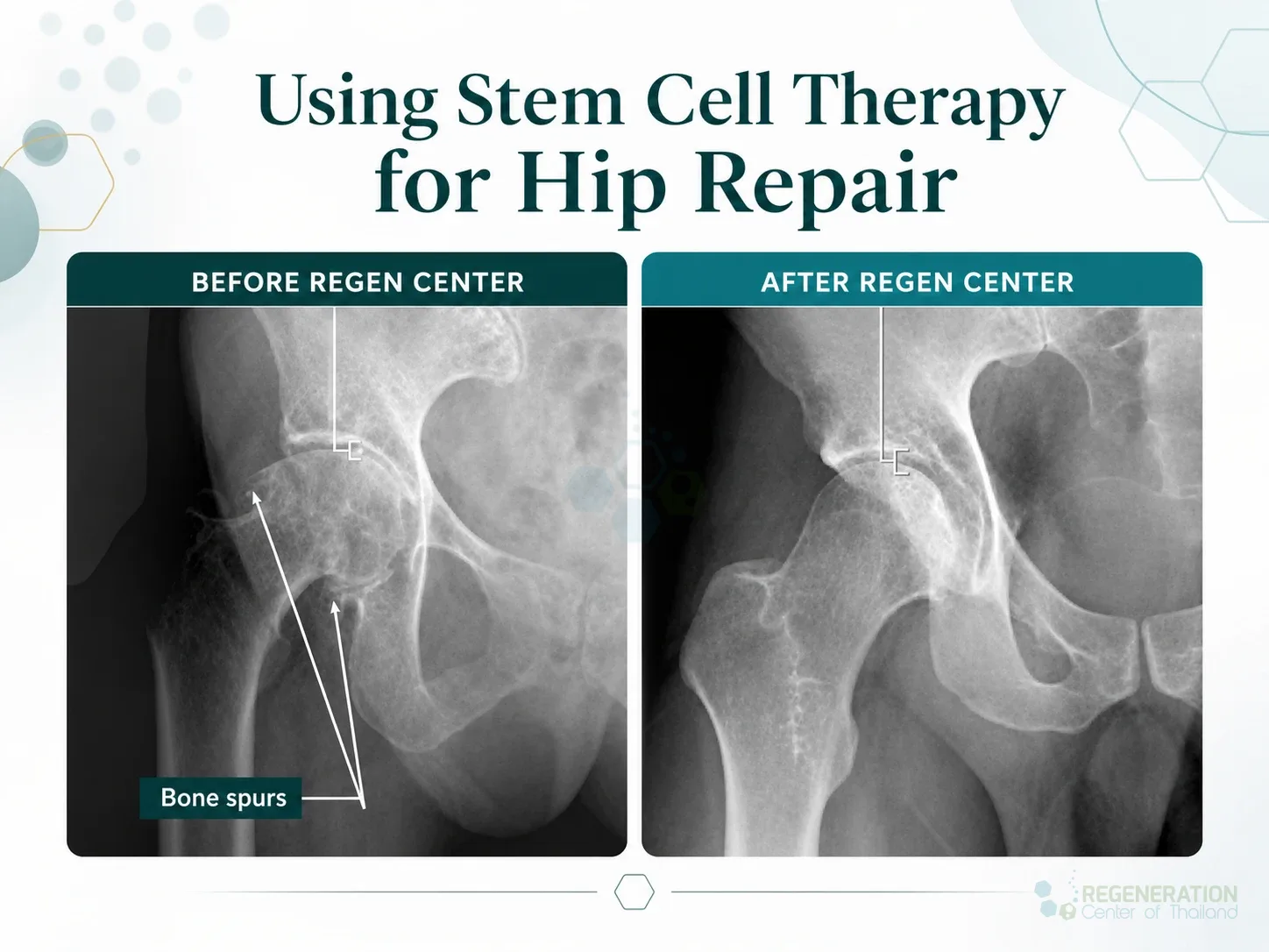Editorial image for Using Stem Cell Therapy for Hip Repair, including the section headline.