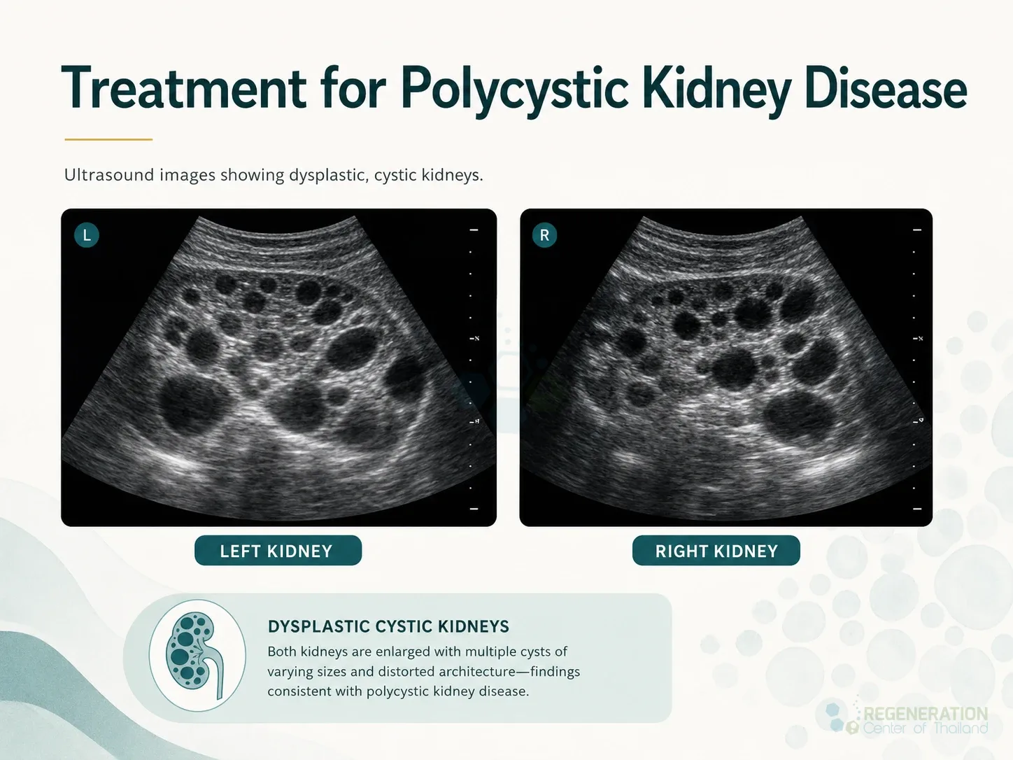 Clinical editorial image for Treatment for Polycystic Kidney Disease, including the section headline.