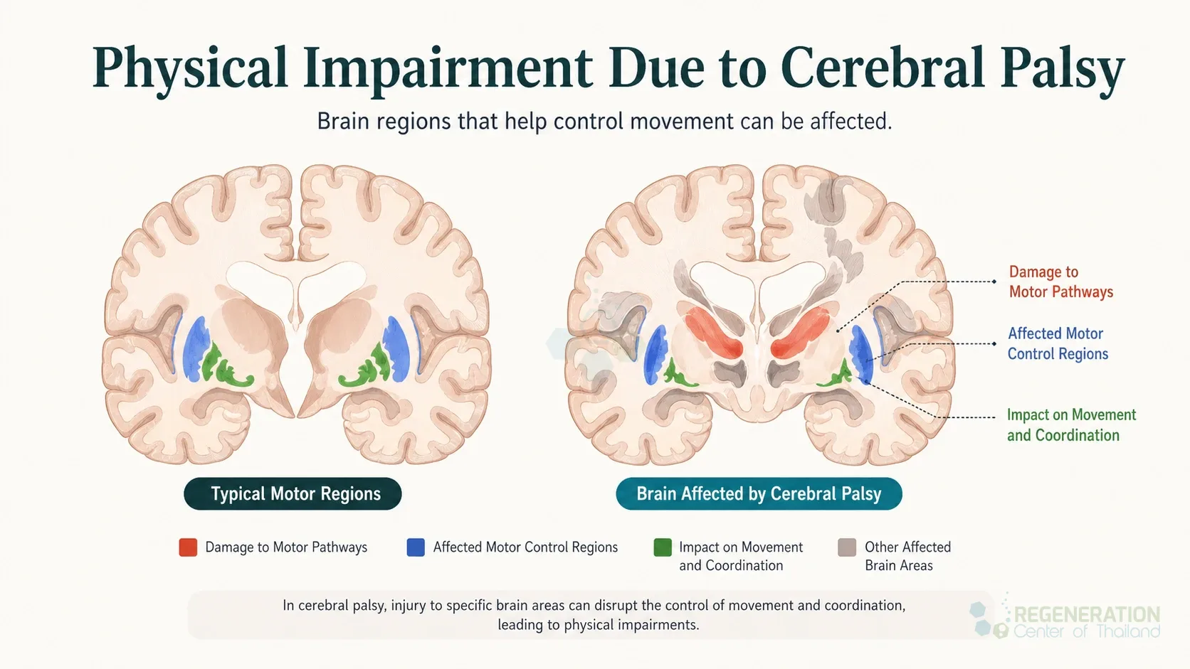 Clinical editorial image for Physical Impairment Due to Cerebral Palsy, including the section headline.