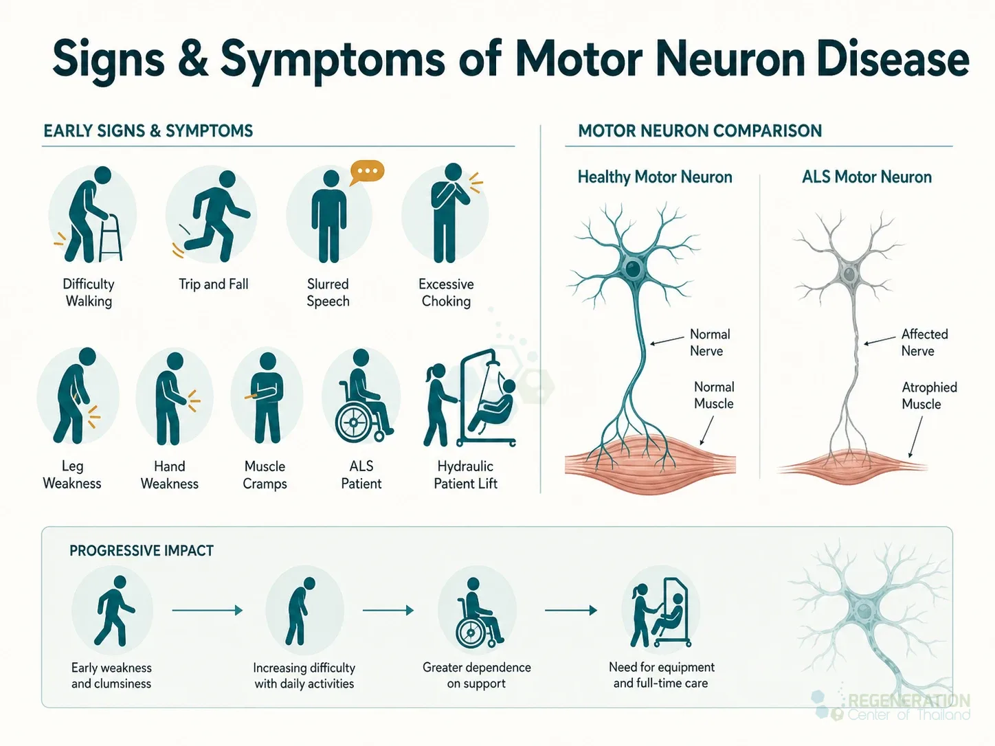 Clinical editorial image for Signs & Symptoms of Motor Neuron Disease, including the section headline.