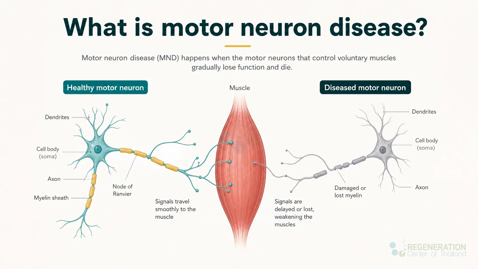 Clinical editorial image for What is motor neuron disease?, including the section headline.
