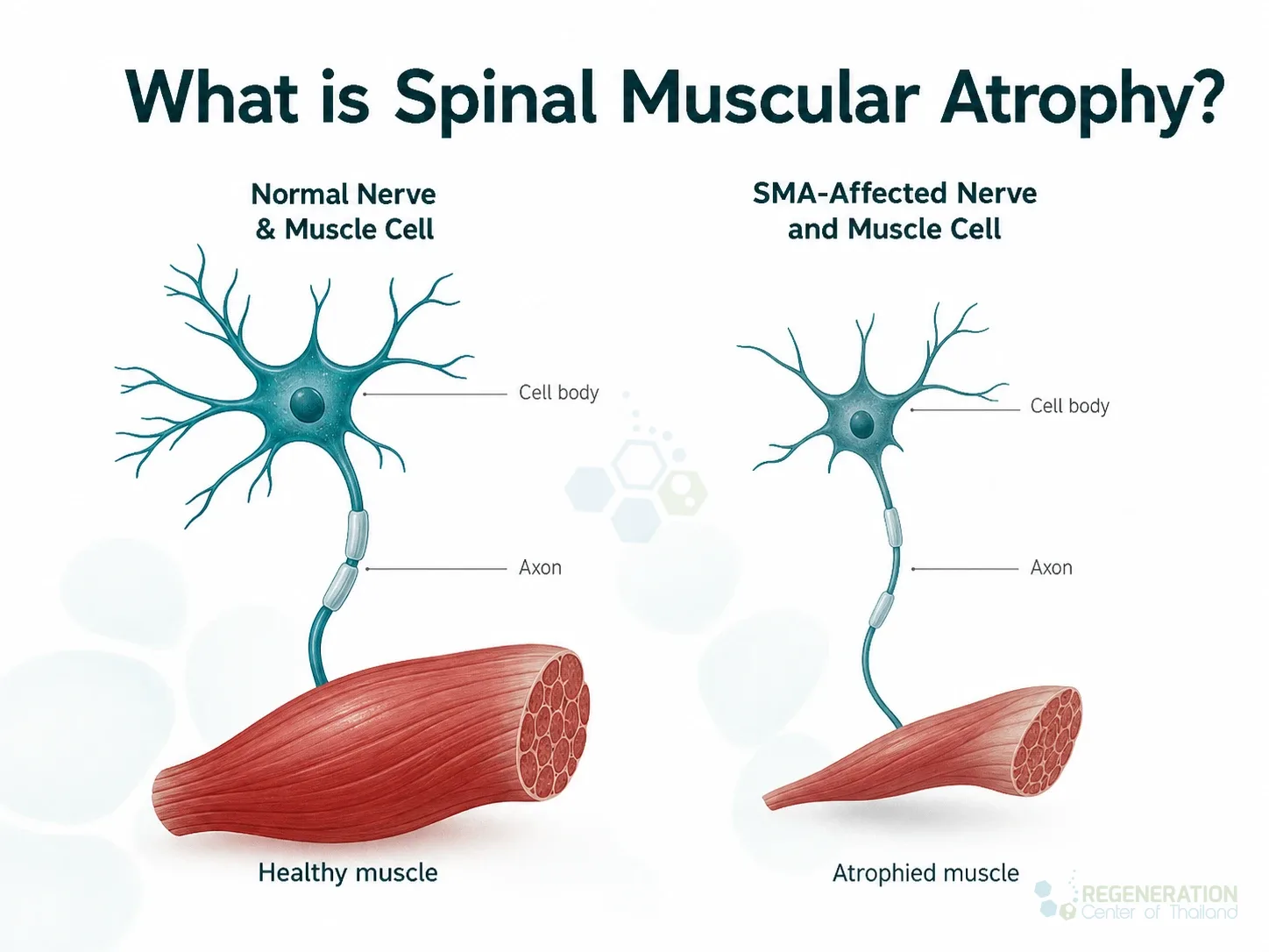 Clinical editorial image for What is Spinal Muscular Atrophy?, including the section headline.