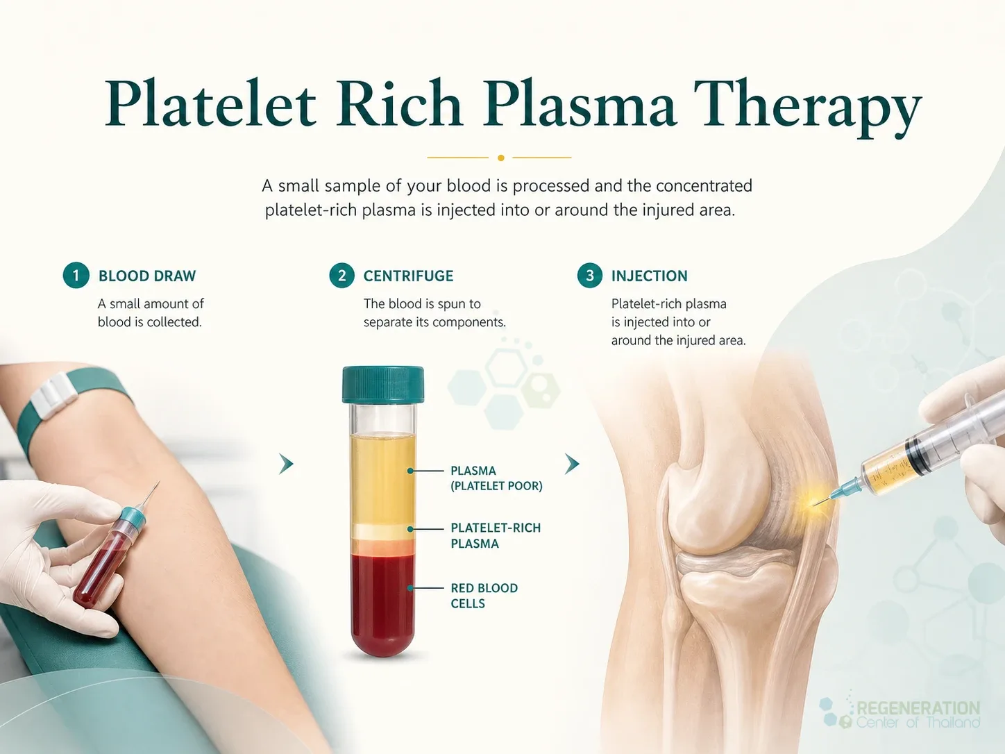 Clinical editorial image for Platelet Rich Plasma Therapy, including the section headline.